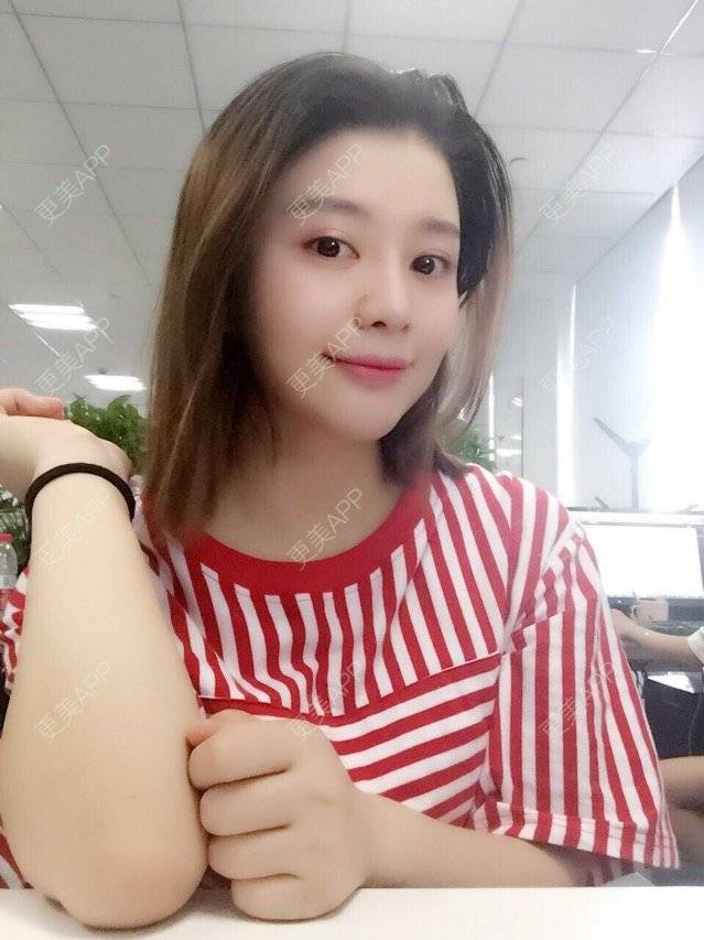 更美 - 唯艺妮子的玻尿酸下巴经验 | 注射美容 | 上海 | 玻尿酸下巴 | 除皱瘦脸