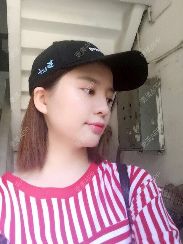 更美 - 唯艺妮子的玻尿酸下巴经验 | 注射美容 | 上海 | 玻尿酸下巴 | 除皱瘦脸