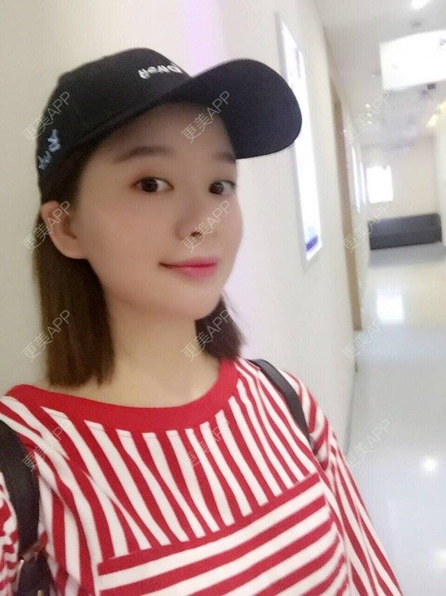 更美 - 唯艺妮子的玻尿酸下巴经验 | 注射美容 | 上海 | 玻尿酸下巴 | 除皱瘦脸