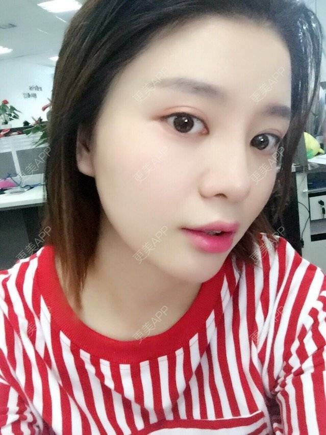 更美 - 唯艺妮子的玻尿酸下巴经验 | 注射美容 | 上海 | 玻尿酸下巴 | 除皱瘦脸