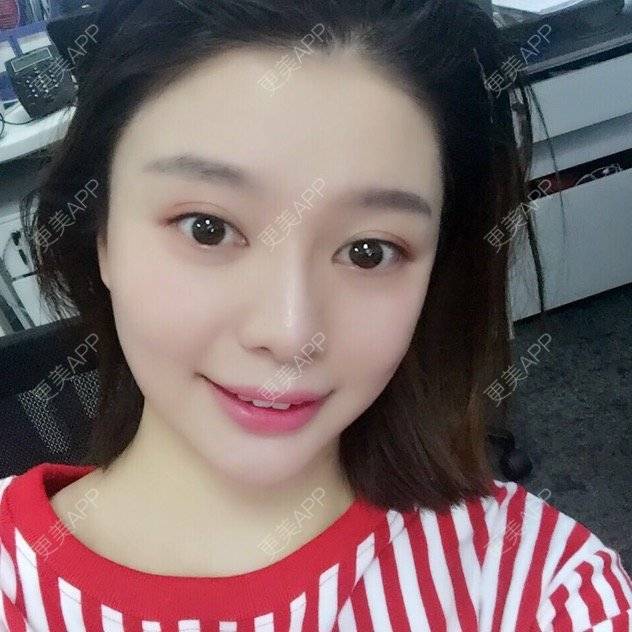 更美 - 唯艺妮子的玻尿酸下巴经验 | 注射美容 | 上海 | 玻尿酸下巴 | 除皱瘦脸