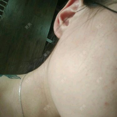 纯中药祛痘大橙 