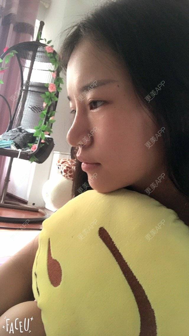 更美 - 我是爱美人士的经验 | 鼻部整形 | 隆鼻 | 下巴 | 商丘