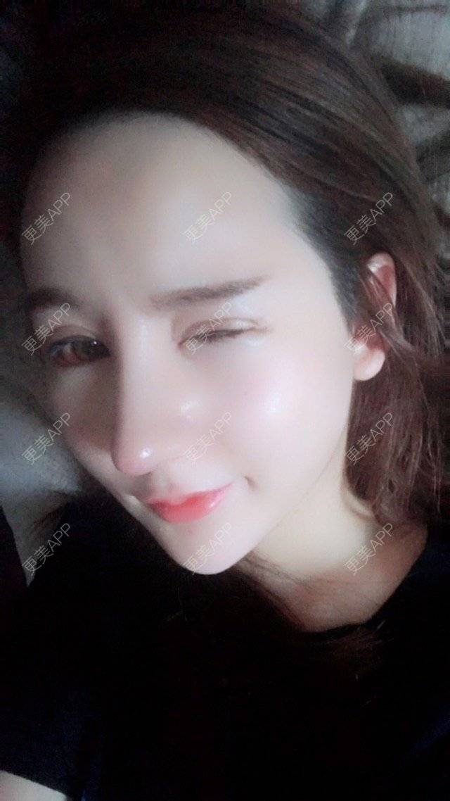 更美 - Cerina的双眼皮修复经验 | 外开眼角 | 双眼皮修复 | 广州