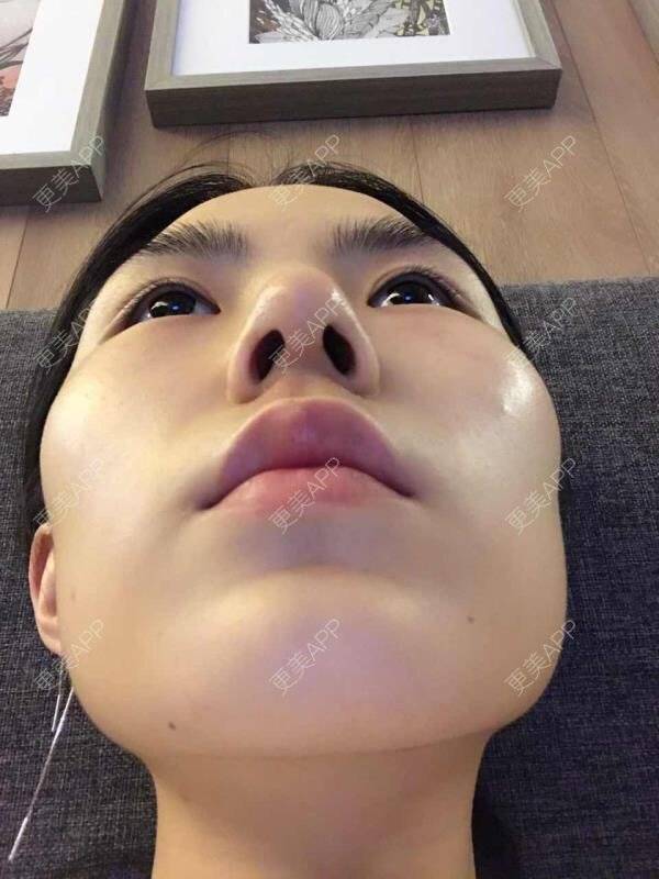 更美 - 大眼小黄人的鼻部膨体假体取出经验 | 上海 | 鼻部膨体假体取出 | 隆鼻 | 鼻部整形