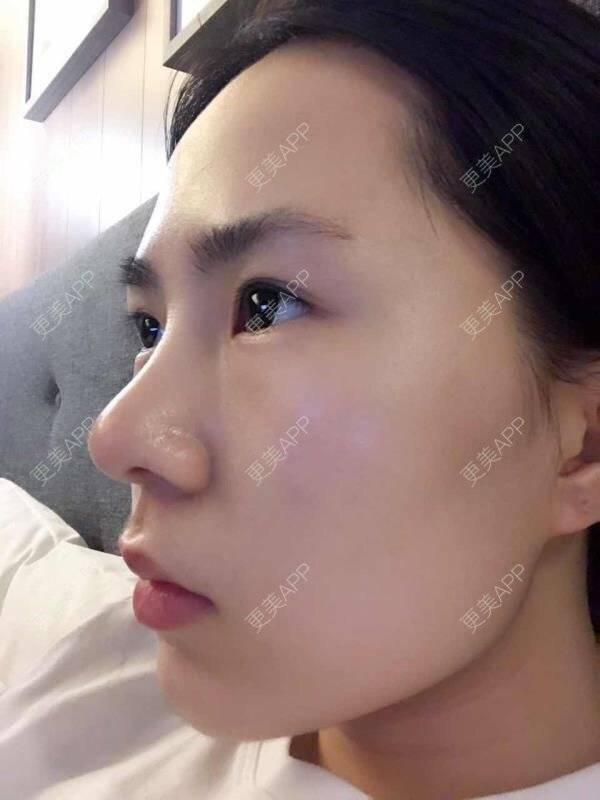 更美 - 大眼小黄人的鼻部膨体假体取出经验 | 上海 | 鼻部膨体假体取出 | 隆鼻 | 鼻部整形
