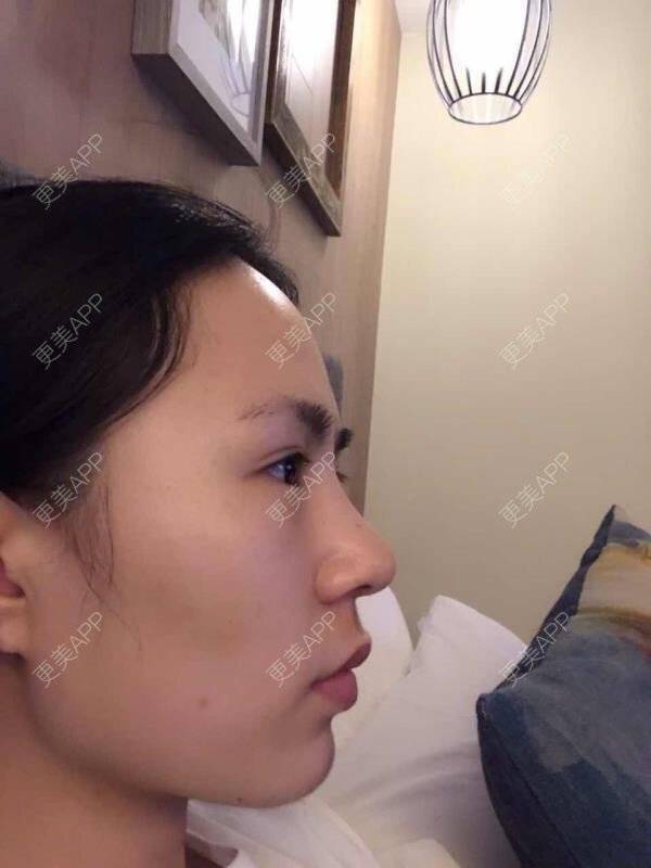 更美 - 大眼小黄人的鼻部膨体假体取出经验 | 上海 | 鼻部膨体假体取出 | 隆鼻 | 鼻部整形