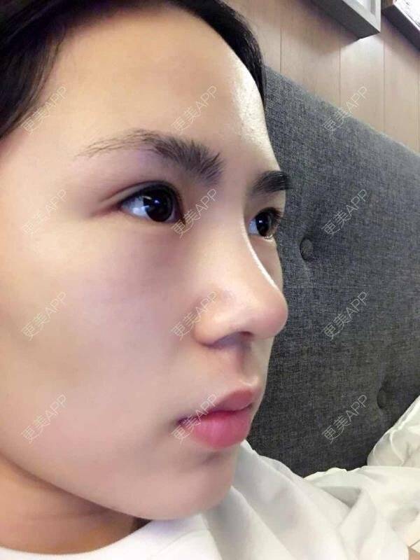 更美 - 大眼小黄人的鼻部膨体假体取出经验 | 上海 | 鼻部膨体假体取出 | 隆鼻 | 鼻部整形