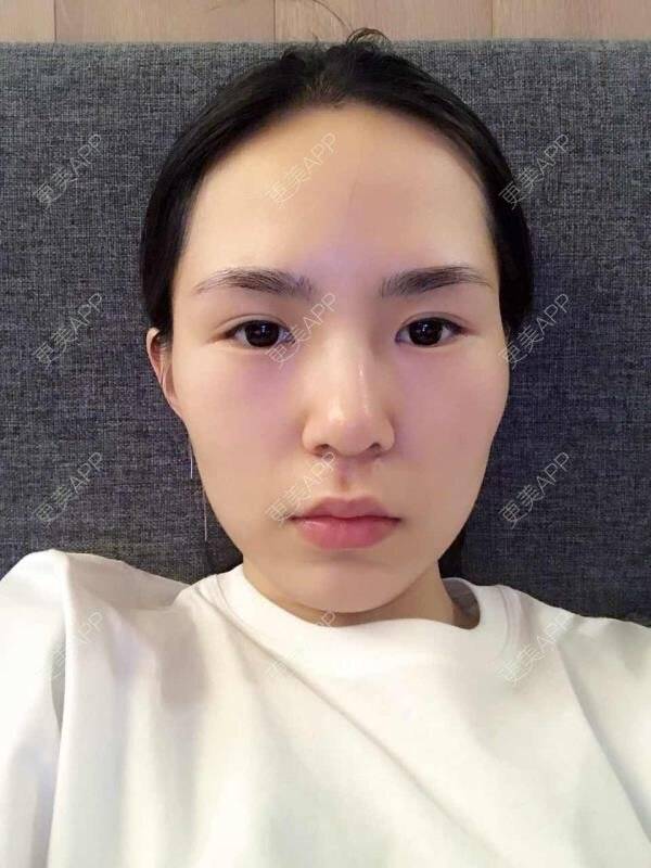 更美 - 大眼小黄人的鼻部膨体假体取出经验 | 上海 | 鼻部膨体假体取出 | 隆鼻 | 鼻部整形