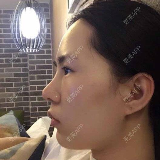 更美 - 大眼小黄人的鼻部膨体假体取出经验 | 上海 | 鼻部膨体假体取出 | 隆鼻 | 鼻部整形