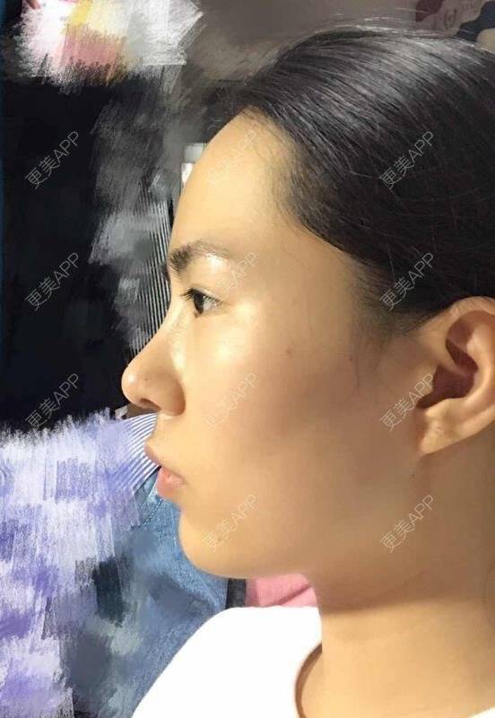 更美 - 大眼小黄人的鼻部膨体假体取出经验 | 上海 | 鼻部膨体假体取出