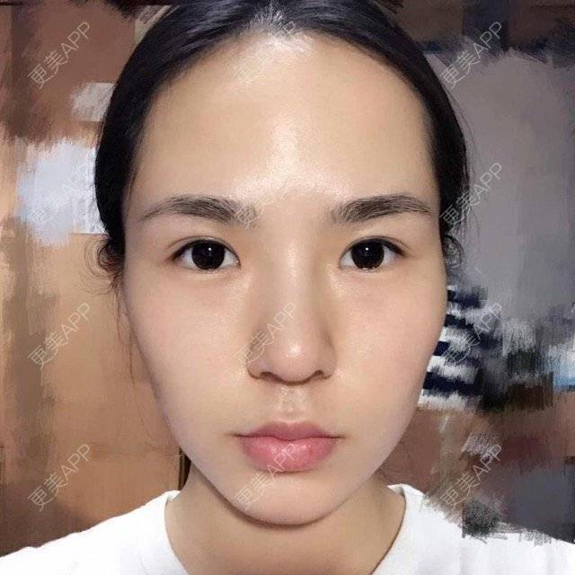 更美 - 大眼小黄人的鼻部膨体假体取出经验 | 上海 | 鼻部膨体假体取出