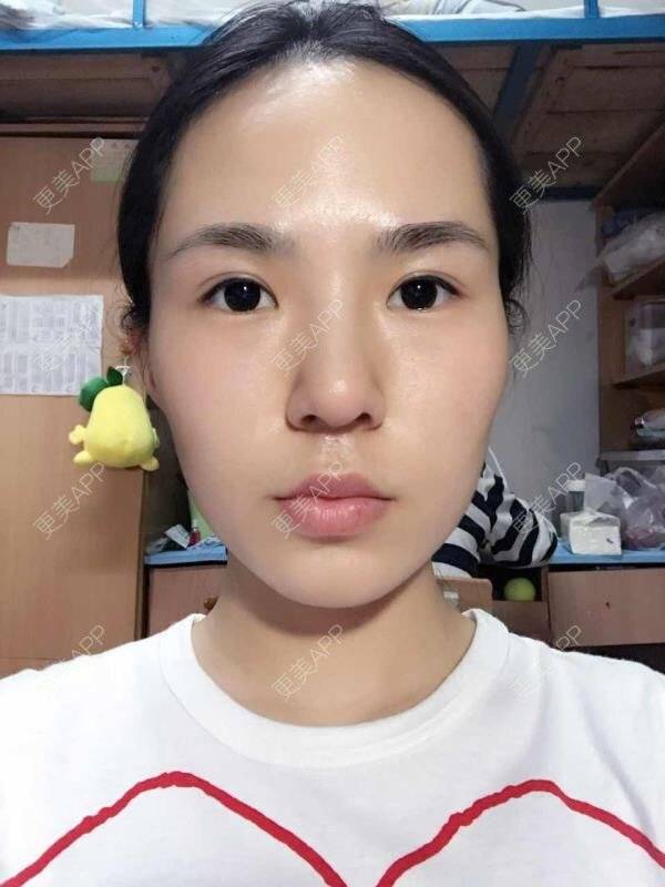 更美 - 大眼小黄人的鼻部膨体假体取出经验 | 上海 | 鼻部膨体假体取出
