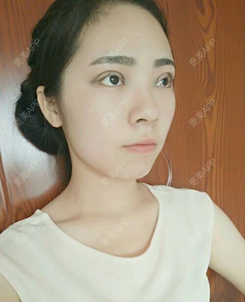 更美 - 浅夏新晴的定点双眼皮经验 | 无痕开眼角 | 术后求抱抱 | 定点双眼皮 | 西安