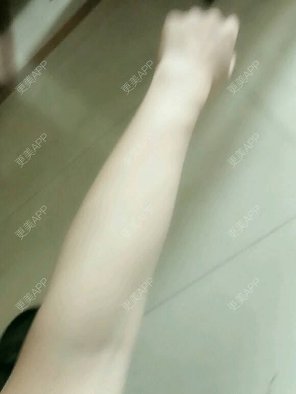 更美 - 网络主播欧美妹子的手臂脱毛经验 | 广州 | 手臂脱毛 | 大腿加小腿激光脱毛 | 脱毛