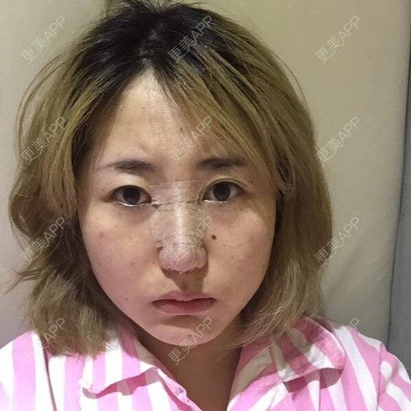 更美 - 花花小姐/.,"的鼻部多项经验 | 膨体隆鼻加耳软骨延长鼻尖 | 鼻部多项 | 重庆