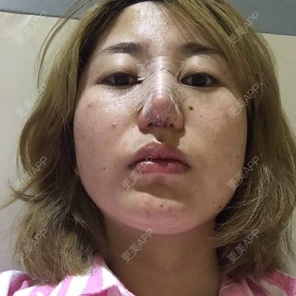 更美 - 花花小姐/.,"的鼻部多项经验 | 膨体隆鼻加耳软骨延长鼻尖 | 鼻部多项 | 重庆