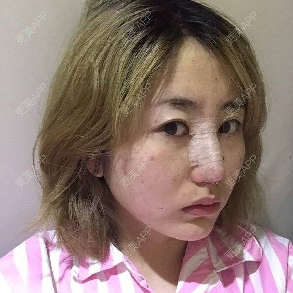 更美 - 花花小姐/.,"的鼻部多项经验 | 膨体隆鼻加耳软骨延长鼻尖 | 鼻部多项 | 重庆