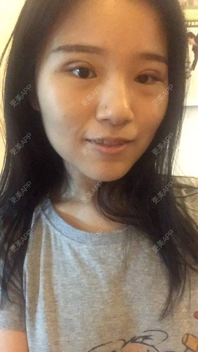 更美 - @蒹葭的眼部多项经验 | 眼部多项 | 双眼皮全切加开眼角 | 深圳