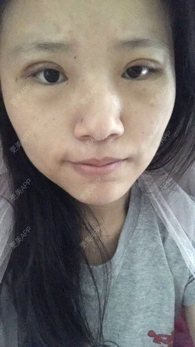 更美 - @蒹葭的眼部多项经验 | 眼部多项 | 双眼皮全切加开眼角 | 深圳