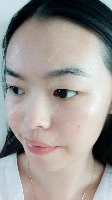 更美 - 更美用户cmPqq1rDGZ的经验 | 激光淡斑 | 激光祛斑和水光针 | 上海