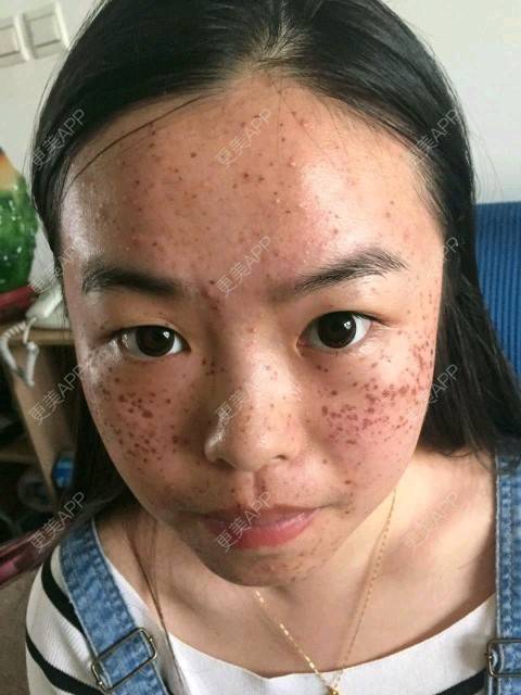 更美 - 更美用户cmPqq1rDGZ的经验 | 激光淡斑 | 激光祛斑和水光针 | 上海