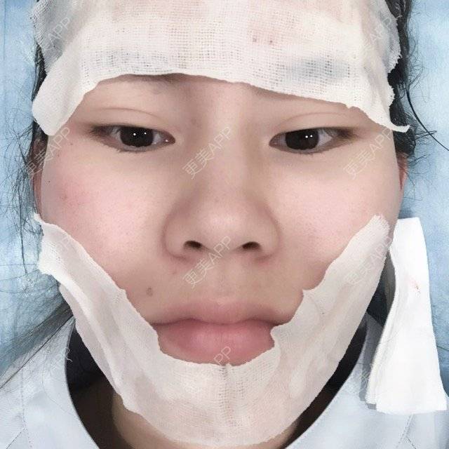 更美 - 婷鑫宝宝的微针水光经验 | 北京 | 北京叶美人 | 滚轮微针 | 微针水光