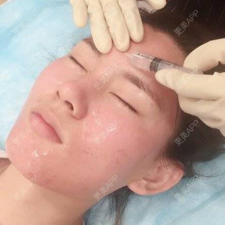 更美 - 婷鑫宝宝的微针水光经验 | 北京 | 北京叶美人 | 滚轮微针 | 微针水光