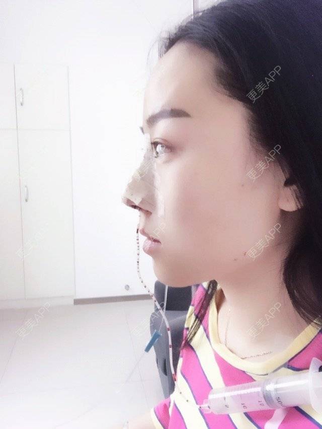 更美 - ''思思💗的鼻部多项经验 | 长沙 | 进口瘦脸针