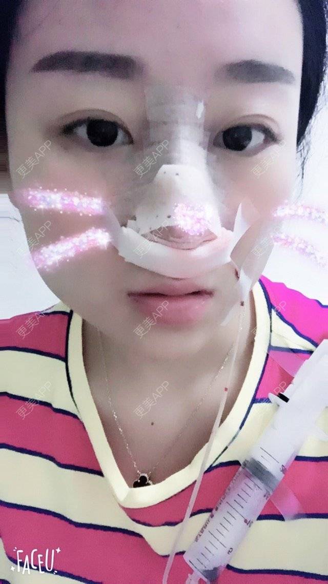 更美 - ''思思💗的鼻部多项经验 | 长沙 | 进口瘦脸针