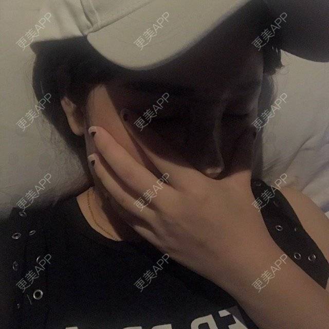 更美 - 傻微的硅胶隆鼻经验 | 鼻小柱延长 | 隆鼻假体 | 上海 | 硅胶隆鼻