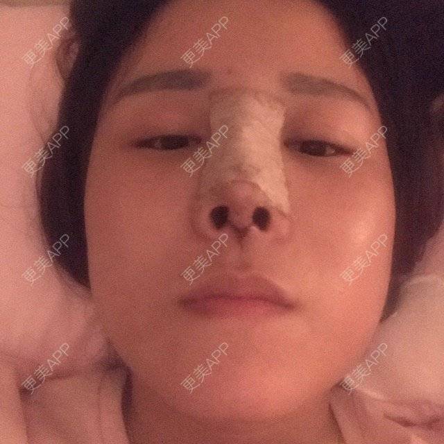 更美 - 傻微的硅胶隆鼻经验 | 鼻小柱延长 | 隆鼻假体 | 上海 | 硅胶隆鼻
