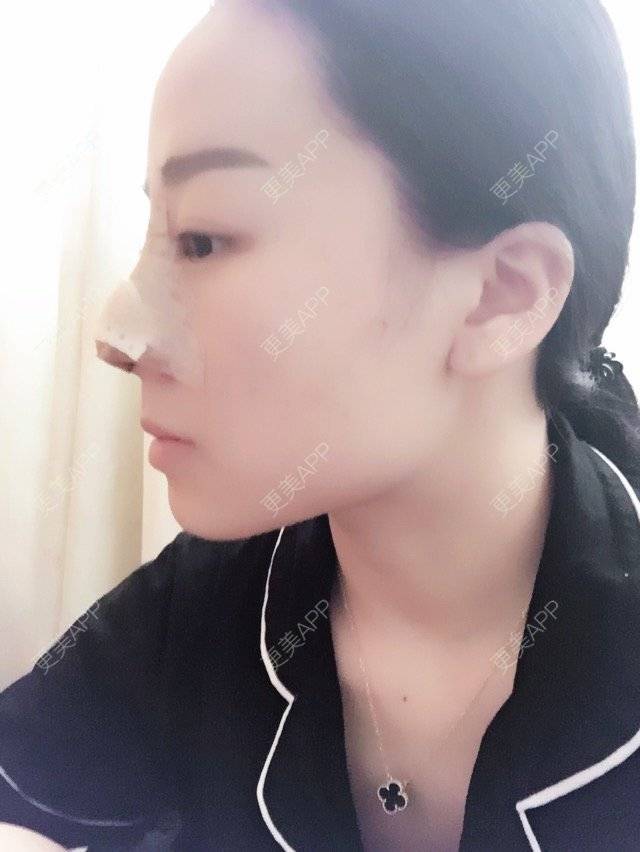 更美 - ''思思💗的鼻部多项经验 | 长沙 | 进口瘦脸针