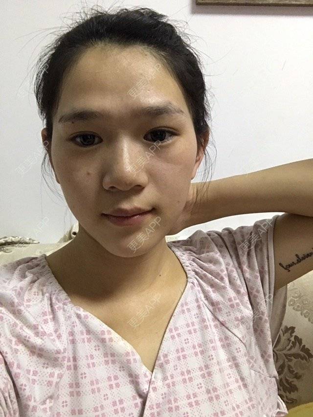 更美 - Z**的吸脂经验 | 成都 | 吸脂