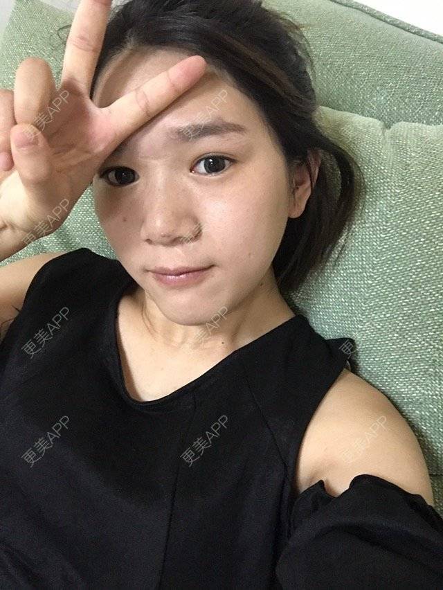 更美 - Z**的吸脂经验 | 成都 | 吸脂