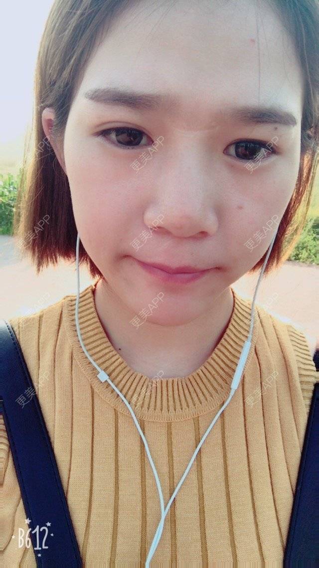 更美 - Z**的吸脂经验 | 成都 | 吸脂