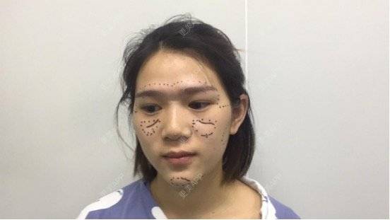 更美 - Z**的吸脂经验 | 成都 | 吸脂