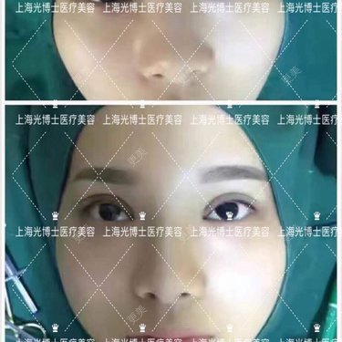 眼部整形1
