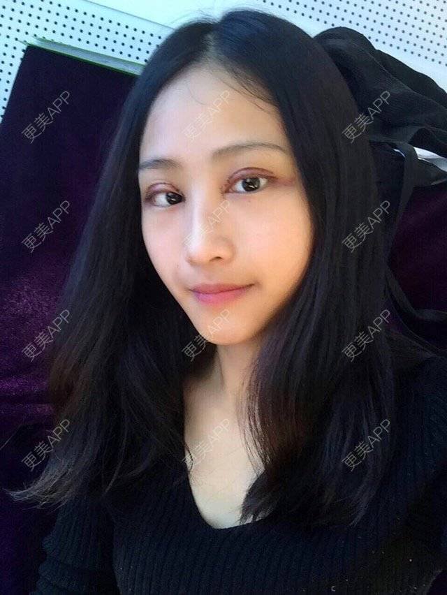 更美 - 欧巴等等我的全切双眼皮经验 | 无痕开眼角 | 全切双眼皮 | 北京