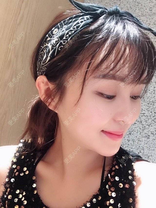 更美 - 小野欣筒的隆鼻经验 | 面吸双下巴 | 北京 | 热门讨论 | 隆鼻
