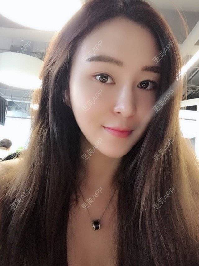 更美 - 小野欣筒的隆鼻经验 | 面吸双下巴 | 北京 | 热门讨论 | 隆鼻