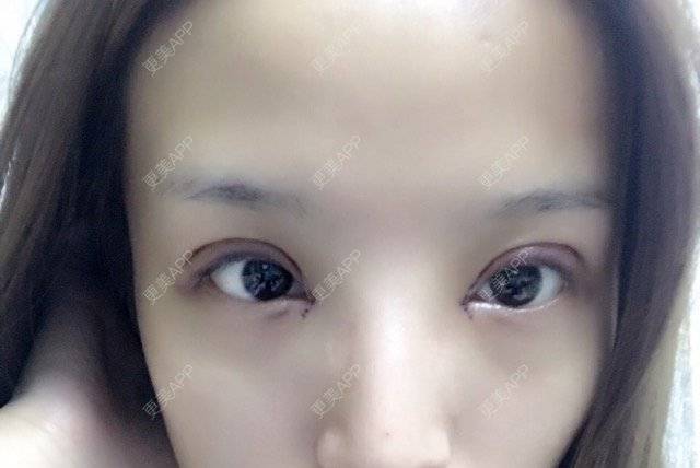 更美 - 很随意，的经验 | 开眼角 | 郑州