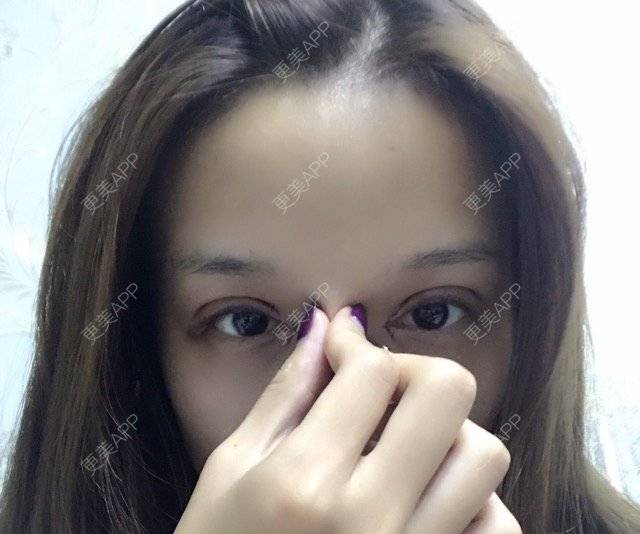 更美 - 很随意，的经验 | 开眼角 | 郑州