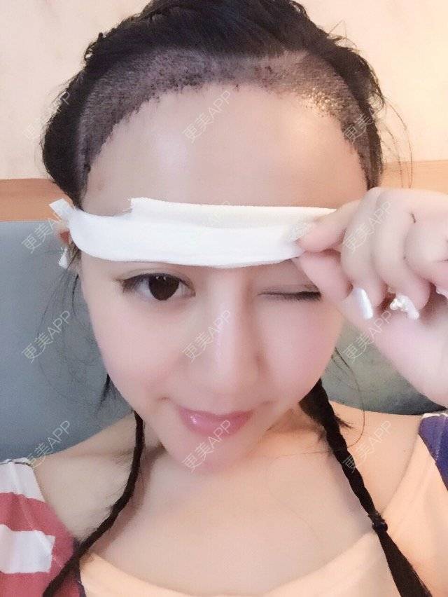 更美 - monica ca的植发际线经验 | 植发际线 | 植发最好的医院 | 北京