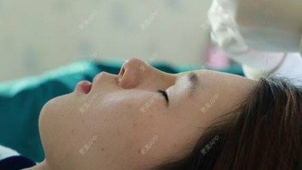 更美 - 邻家小姐姐的埋线隆鼻经验 | 注射美容 | 广州 | 玻尿酸注射鼻子 | 埋线隆鼻
