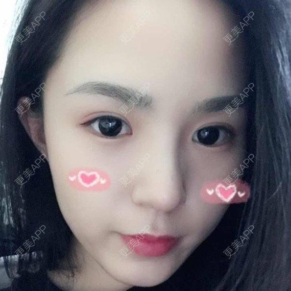 更美 - 大眼小黄人的鼻部膨体假体取出经验 | 上海 | 鼻部膨体假体取出