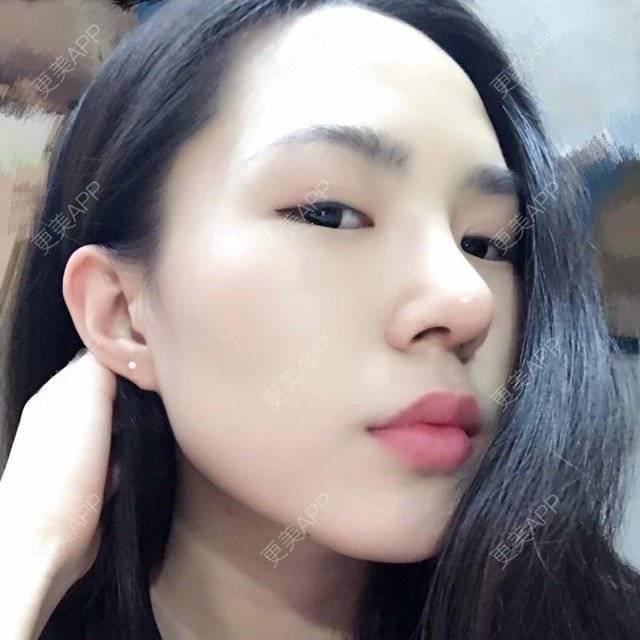 更美 - 大眼小黄人的鼻部膨体假体取出经验 | 上海 | 鼻部膨体假体取出