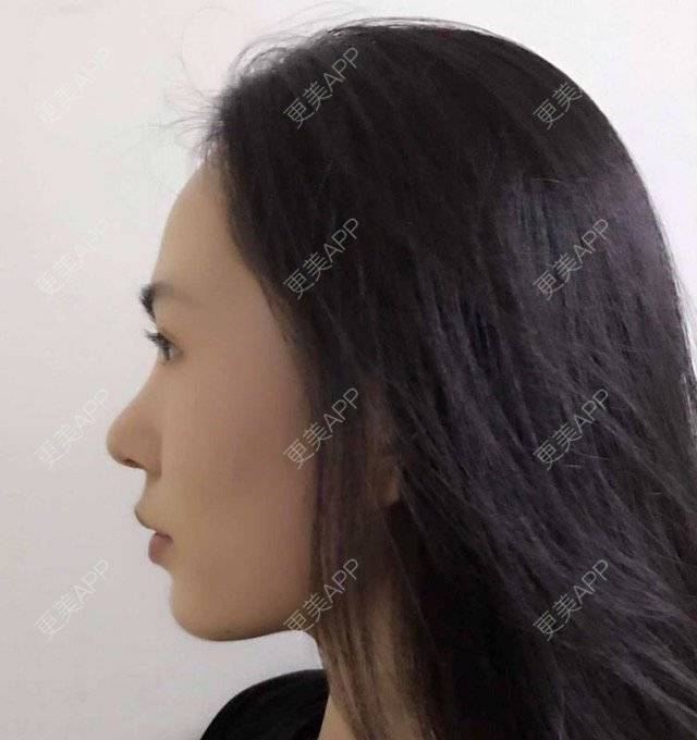 更美 - 大眼小黄人的鼻部膨体假体取出经验 | 上海 | 鼻部膨体假体取出