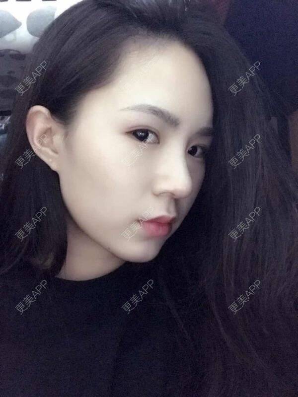 更美 - 大眼小黄人的鼻部膨体假体取出经验 | 上海 | 鼻部膨体假体取出