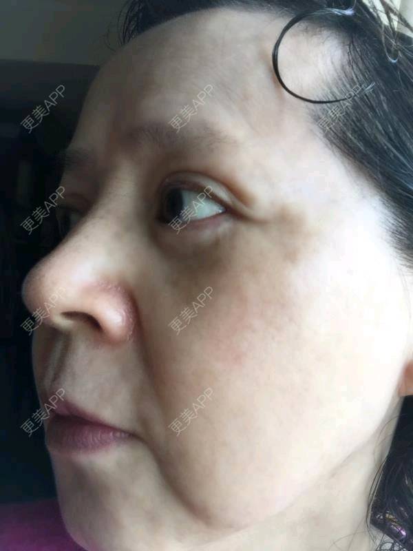 更美 - 僧庐听雨的超声提升经验 | 超声提升 | 重庆 | 去皱纹 | 极线音波拉皮